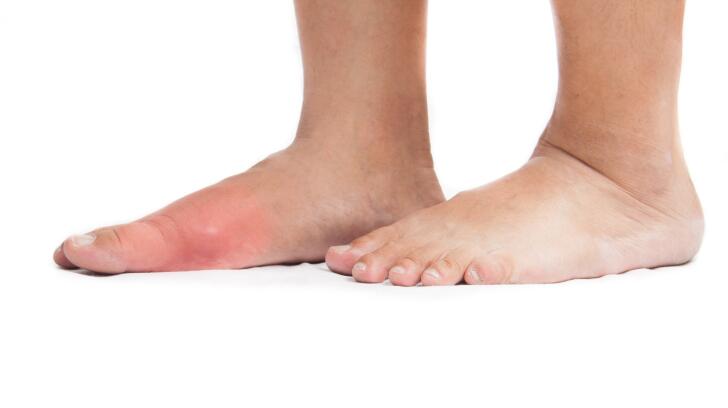 What Gout Looks Like