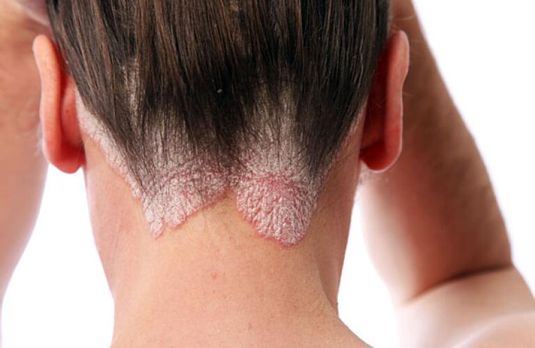 over the counter topical treatment for scalp psoriasis)