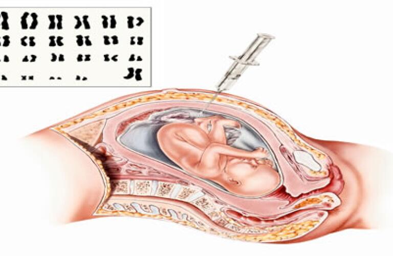 Amniocentesis Amniotic Fluid Test Why It S Done Risks What To Expect Amniocentesis Amniotic Fluid Test Why It S Done Risks What To Expect