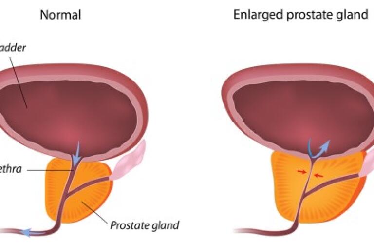 Transurethral Resection Of The Prostate Turp Procedure Transurethral Resection Of The Prostate Turp Procedure