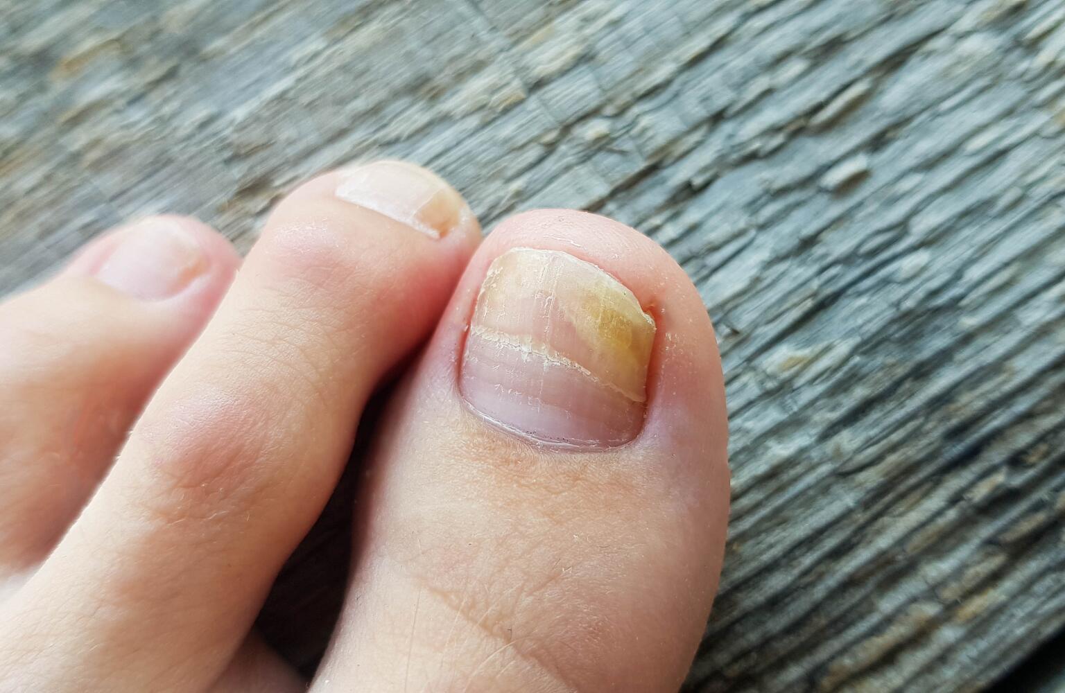 Toenail Problems Fungus, Thickening & Yellow Toenails