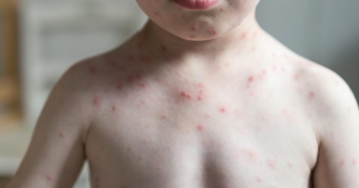 5 Common Rash Conditions in Children