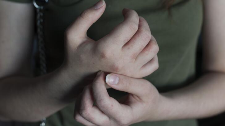 10 Things To Know About Scabies Skin Mites