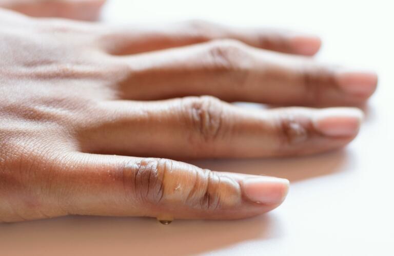 stages of burn healing for 2nd degree burn stages of burn healing for 2nd degree burn