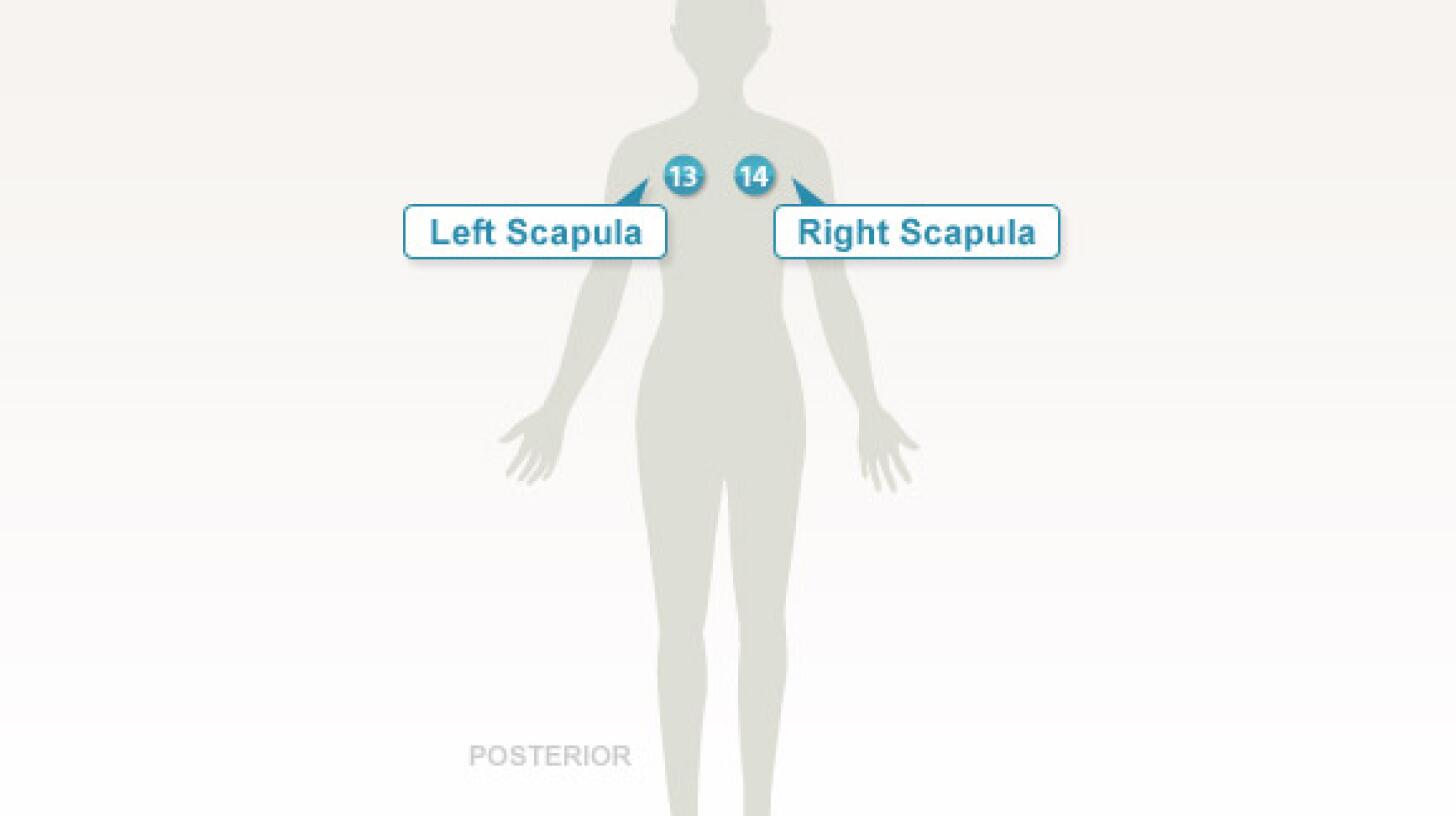The Tender Points of Fibromyalgia