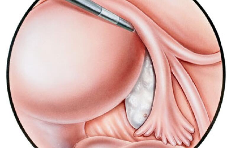Pelvic Laparoscopy