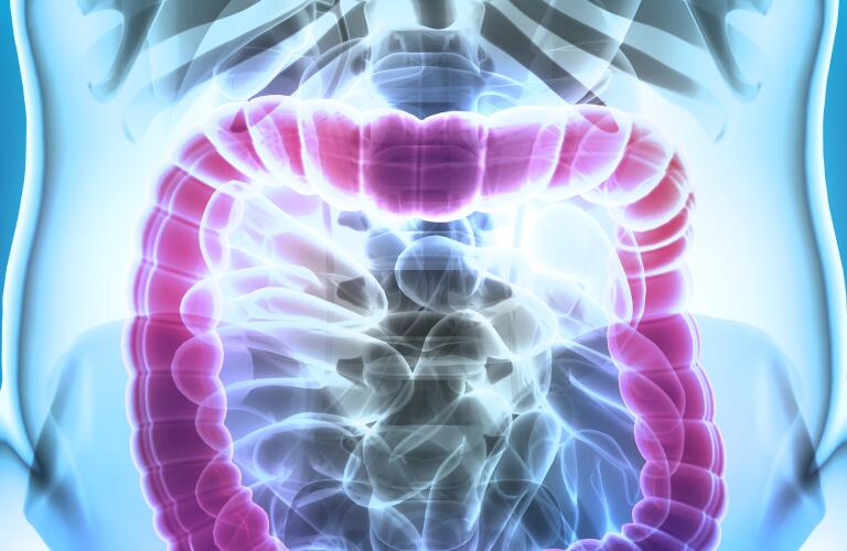 Crohn S Disease Cancer Colorectal Cancer Risk With Crohn S Crohn S Disease Cancer Colorectal Cancer Risk With Crohn S