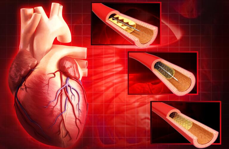 Angioplasty