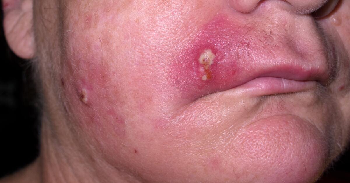 Staph Infection Symptoms Causes Treatment Staphylococcus Aureus