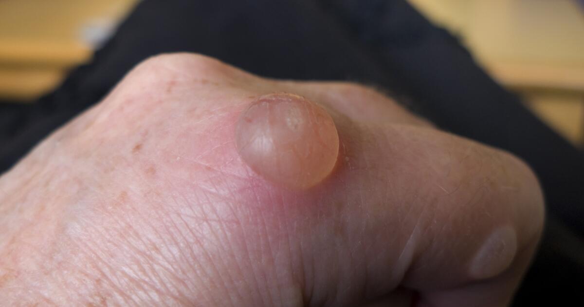 Blisters Symptoms Causes Treatments