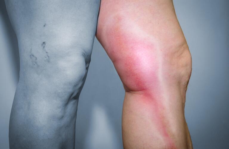 Thrombophlebitis in human leg
