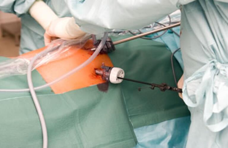 Laparoscopy - Laparoscopic Surgery Laparoscopy - Laparoscopic Surgery