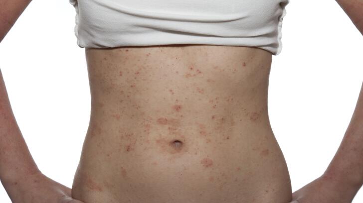 what eczema looks like eczema on baby on the face on the hands