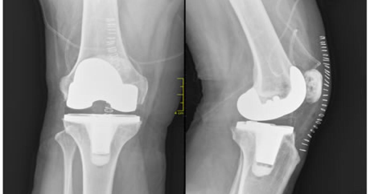 Knee Replacement Right Care Center Knee Replacement Right Care Center