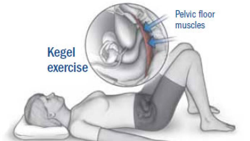 Keeping Up With Kegel Exercises