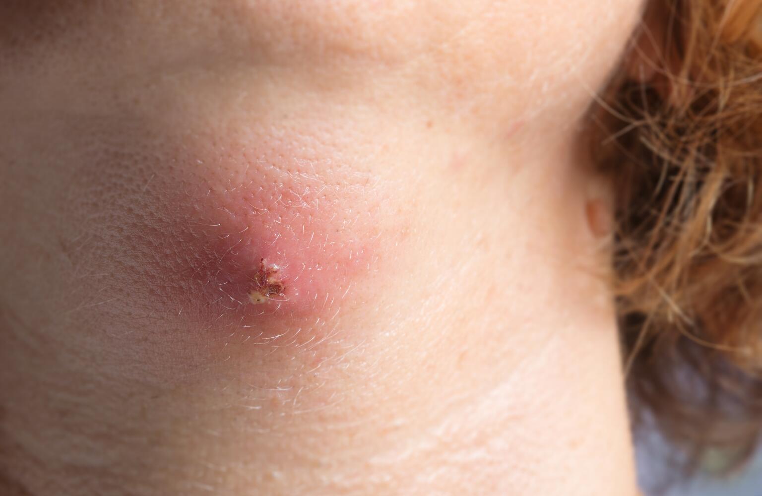 Abscess Causes, Symptoms, Treatments & Complications