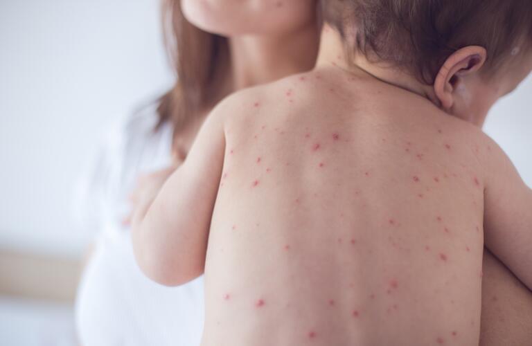 Diaper Rash To Kids Eczema When To See A Pediatrician For A Rash