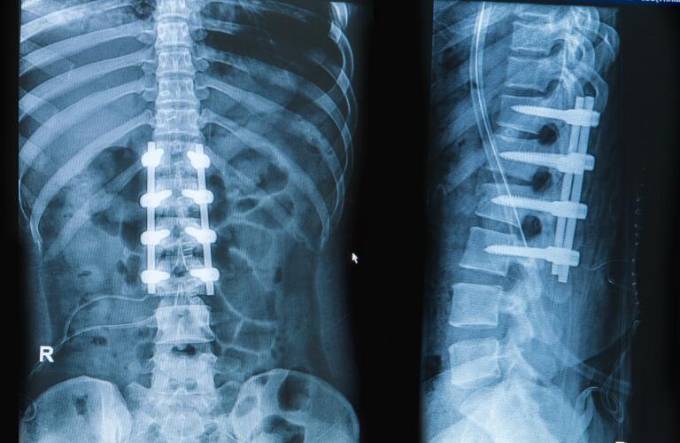 xray image of partially fused spine with screws