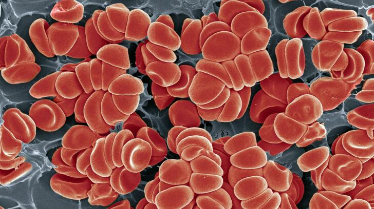 Know The 5 Warning Signs Of A Dvt Blood Clot In Your Leg