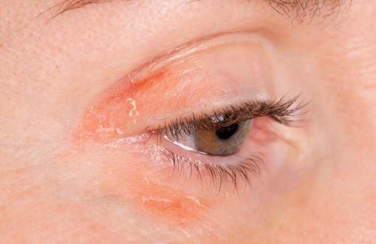 Face Psoriasis What to Do for Psoriasis Near Eyes