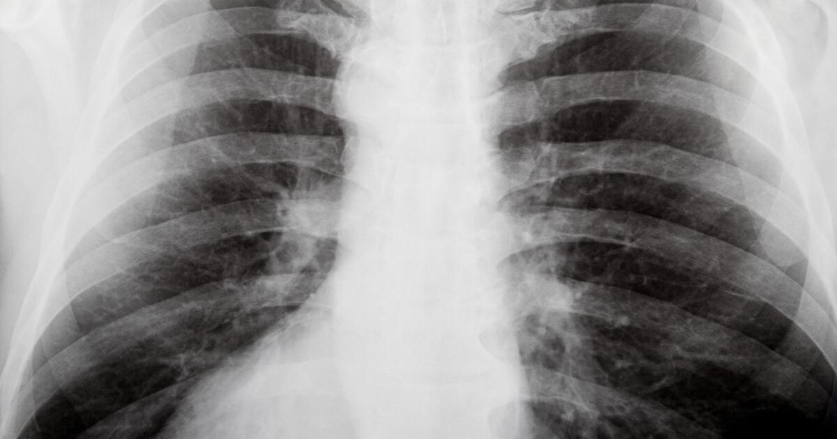 Intercostal Neuralgia