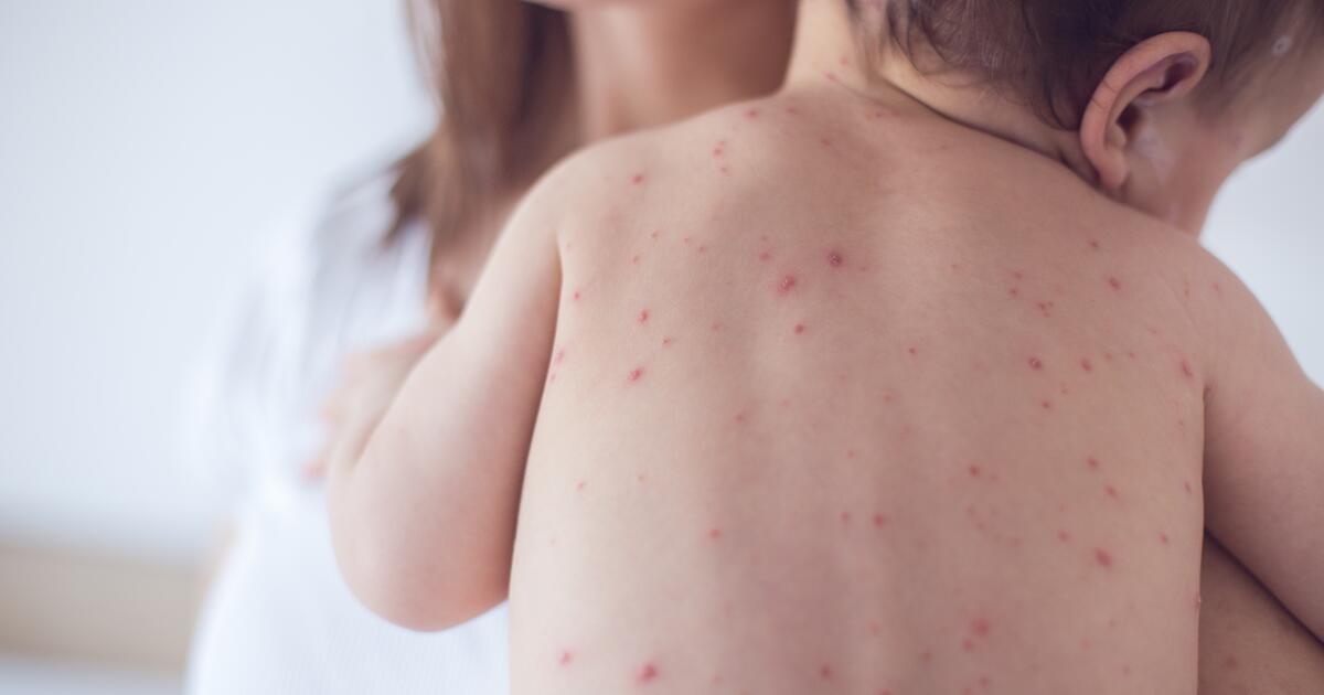Will chicken pox comes twice