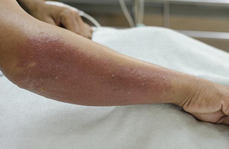 arm-with-blisters