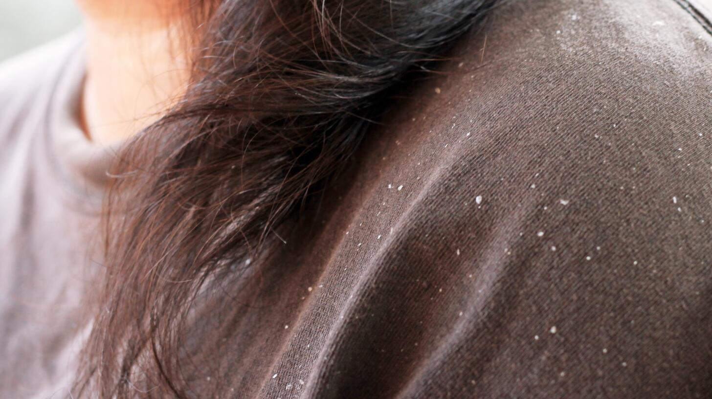 8 Things to Know About Dandruff Causes & Remedies