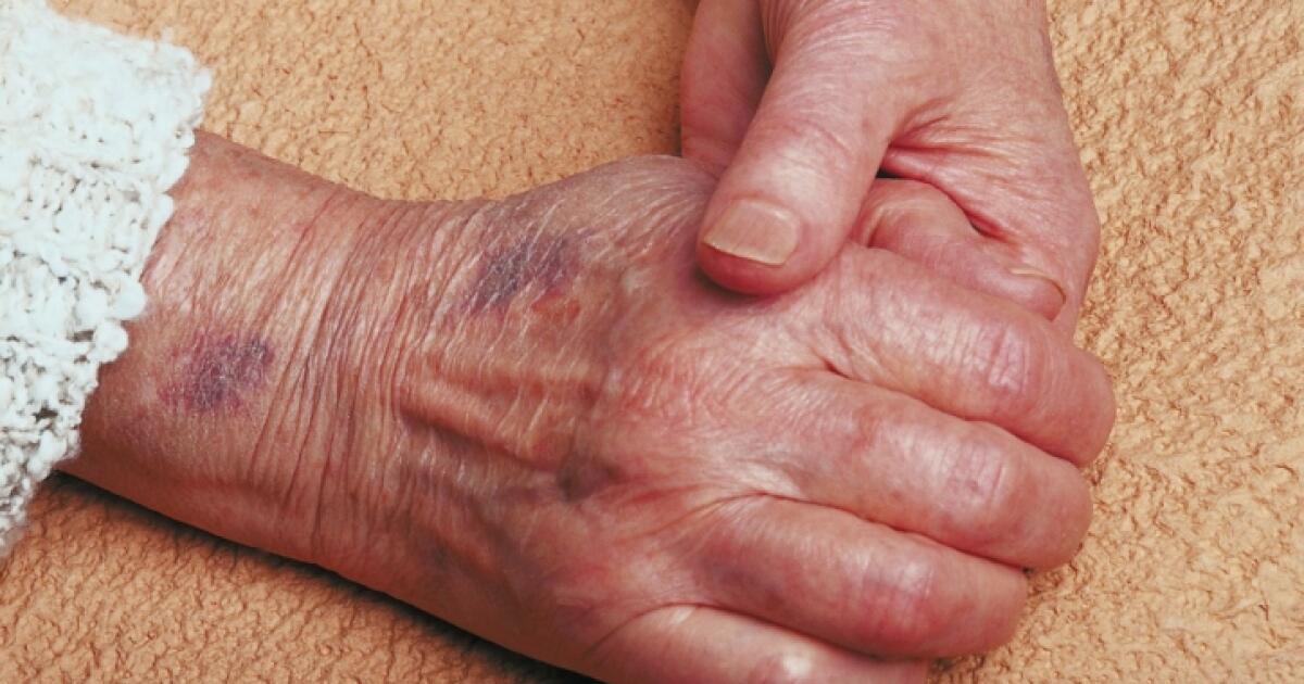 Bulging Veins Symptoms Causes Treatments