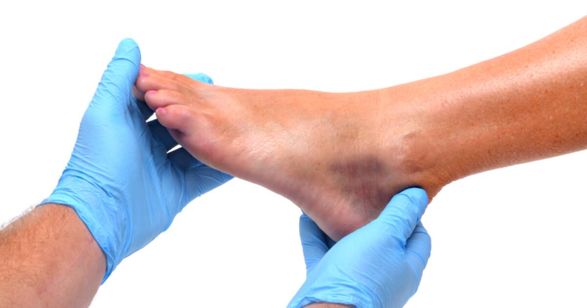 Foot Bruise