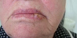 Mouth Cancer Pictures What Oral Cancer Sores Look Like