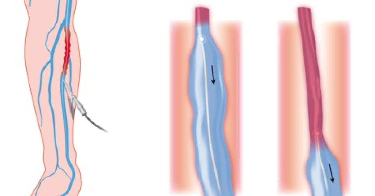 varicose review tratament laser