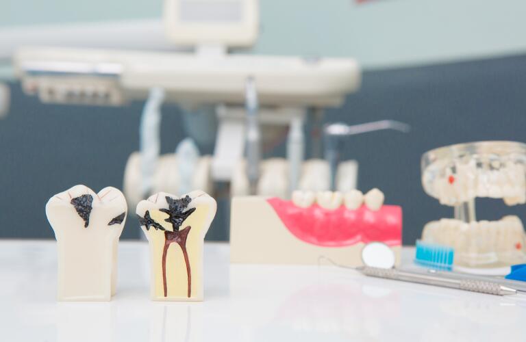 dental tooth model with cavity down to root