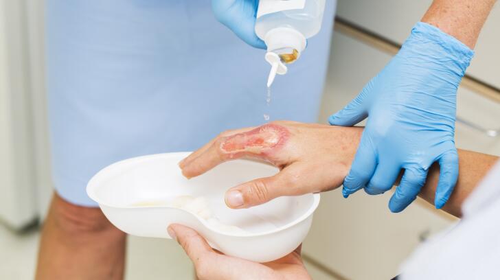 10 Things To Know About Burns How To Treat 2nd And 3rd Degree Burns