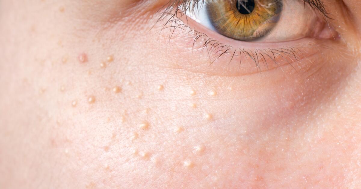 Milium Cyst (Milia) What It Is & How to Get Rid of It