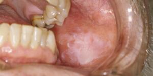 Mouth Cancer Pictures | What Oral Cancer Sores Look Like Mouth Cancer Pictures | What Oral Cancer Sores Look Like