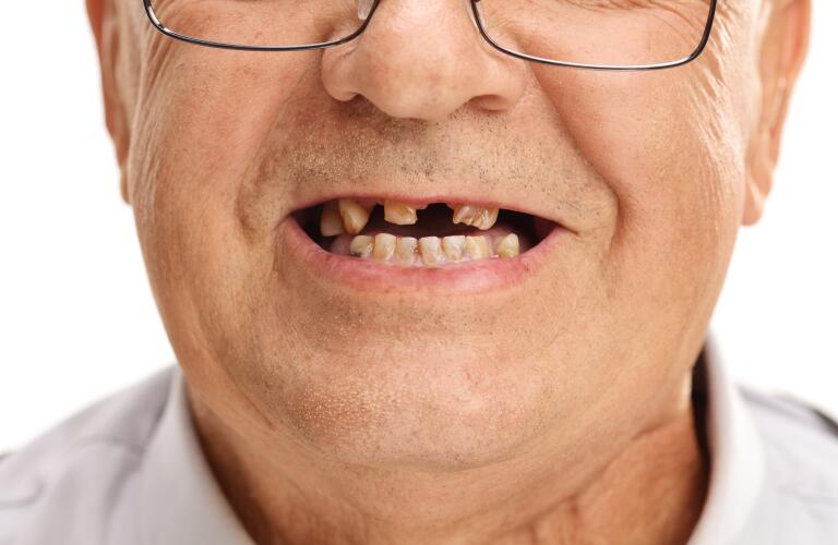 Missing teeth