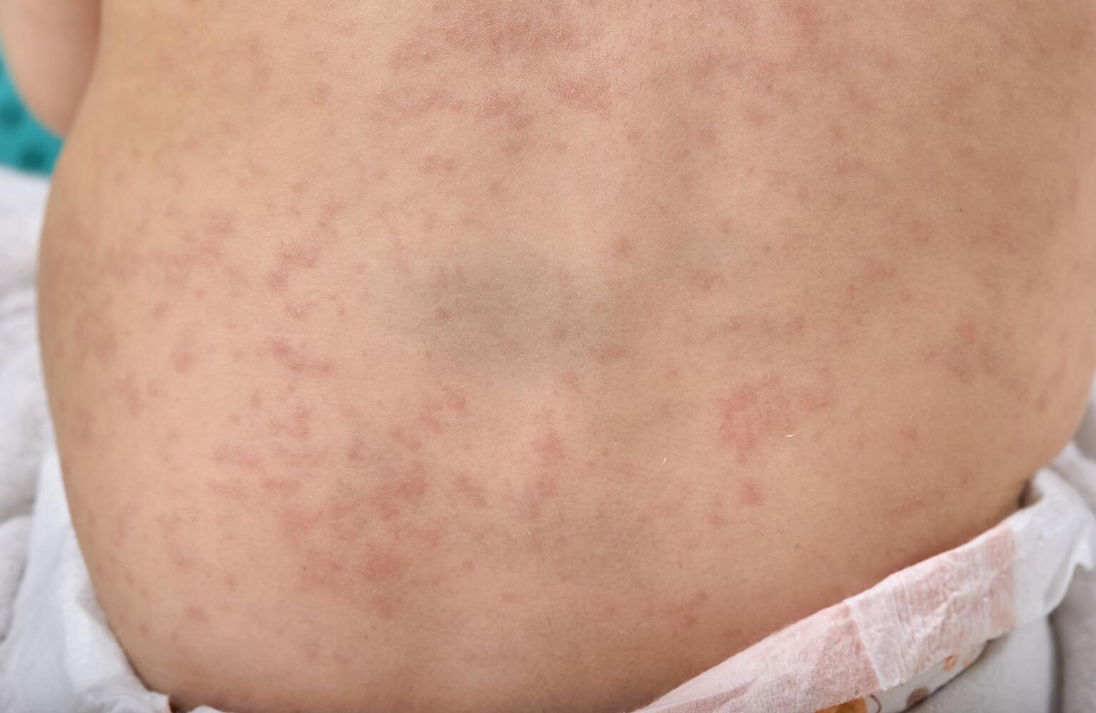 Stomach rash symptoms causes treatment stomach rash itchy vs not