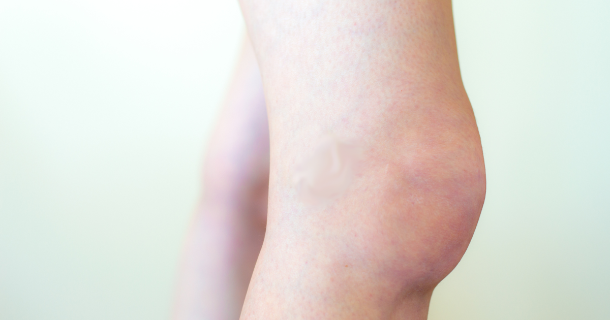 Knee Swelling Symptoms Causes Treatments