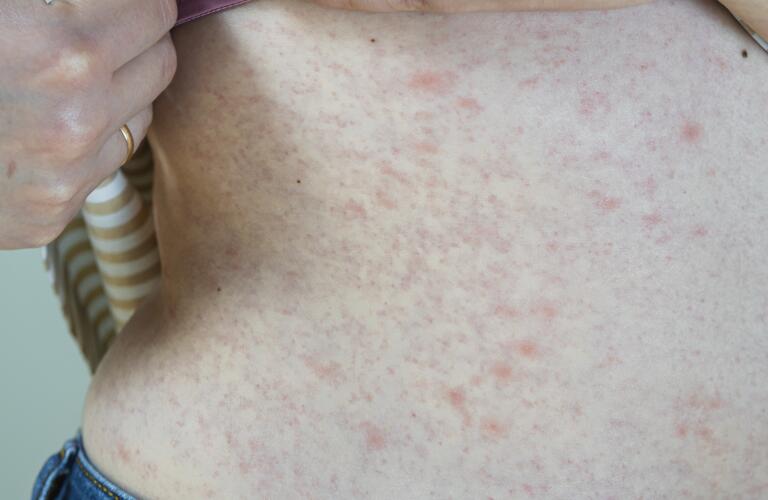 Stomach Rash Symptoms Causes Treatment Stomach Rash Itchy Vs Not Itchy