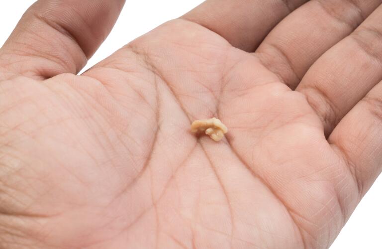 Tonsil Stones Causes, Symptoms, Treatment & Removal Tonsilloliths