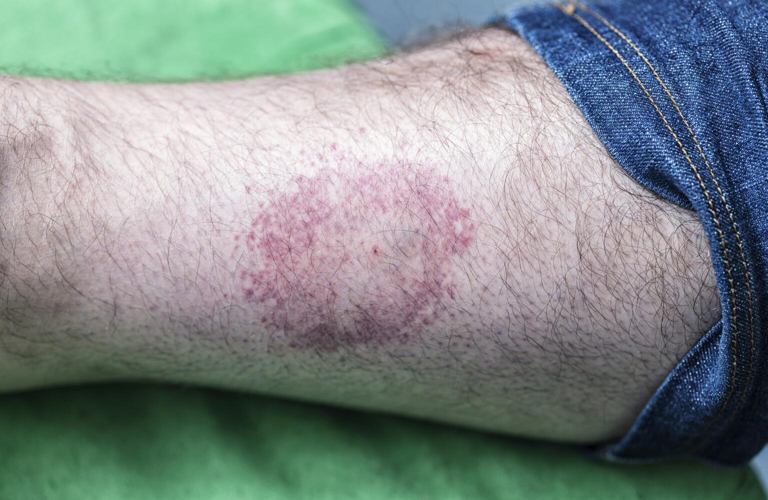 Lyme Disease Symptoms, Causes & Treatment