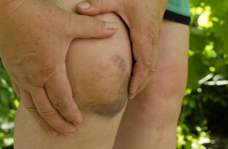 Closeup of woman with hematoma or bad bruise on knee