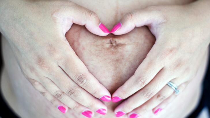 9 Things To Know About Stretch Marks Causes Treatments