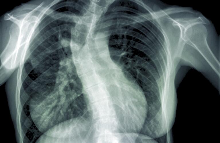 Scoliosis of the spine, X-ray