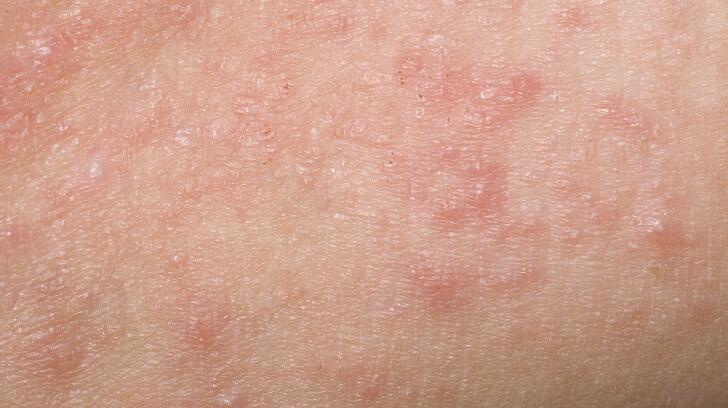 9 Effects Of Hepatitis C On Your Body 9 Effects Of Hepatitis C On Your Body