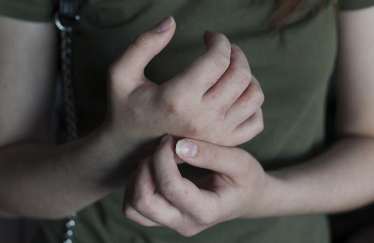 itchy hands with irritated skin rash