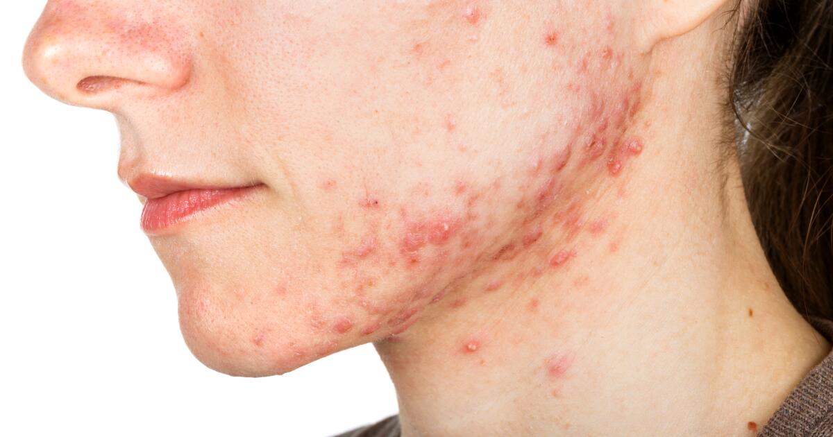 Nodular Acne Treatment Causes Symptoms Acne Nodules nodular-acne-treatment-causes-symptoms-acne-nodules