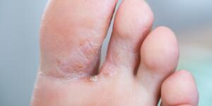 7 Types Of Foot Rashes How To Treat Them Causes Of Foot Rash 7 Types Of Foot Rashes How To Treat Them Causes Of Foot Rash