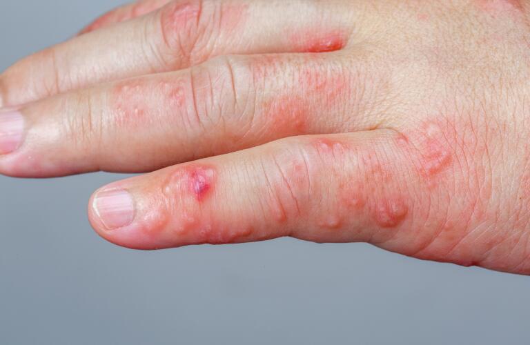 picture of shingles on hand        <h3 class=